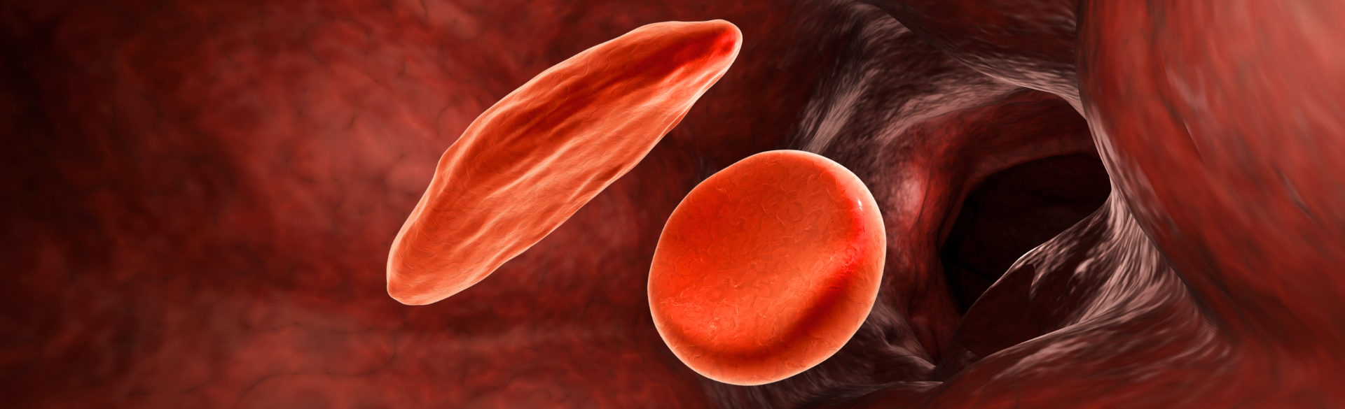 Clinical Trial For Gene Therapy Treatment Cures Sickle Cell Disease   Sickle Cell Blog 